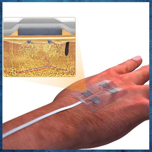 Wirelessly-controlled bandage to heal chronic wounds